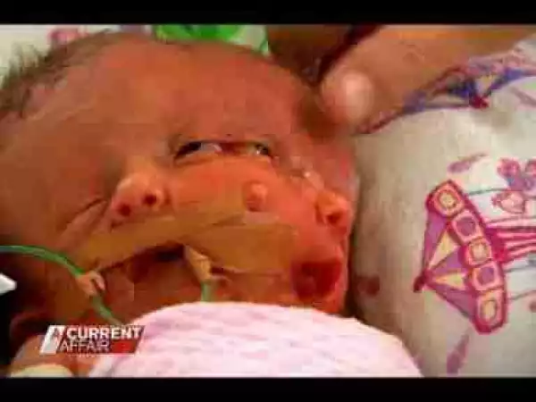 Shocking...!!! See The Baby Born With 1 Head And 2 Faces In Australia
